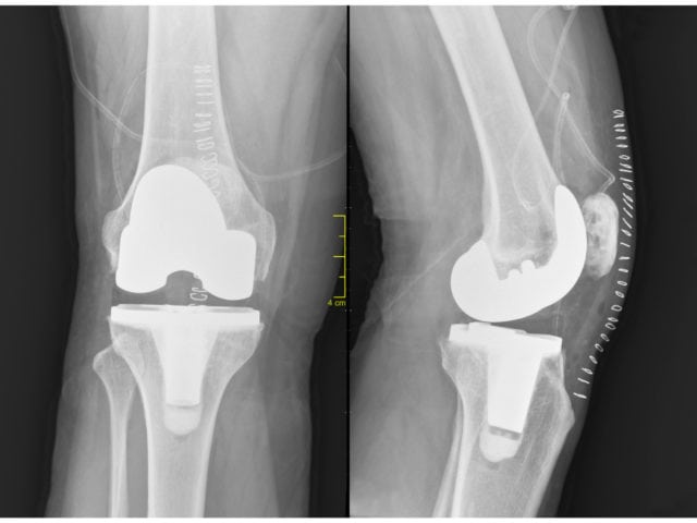Total Knee Replacement