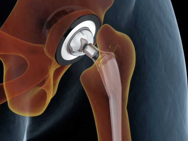 joint replacement surgery
