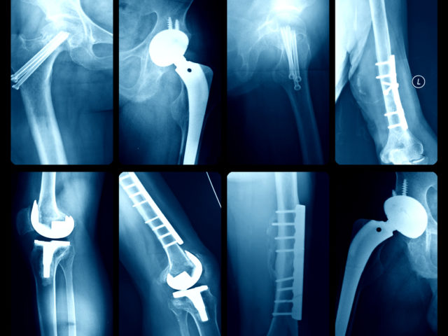 Joint-Fusion Surgeries