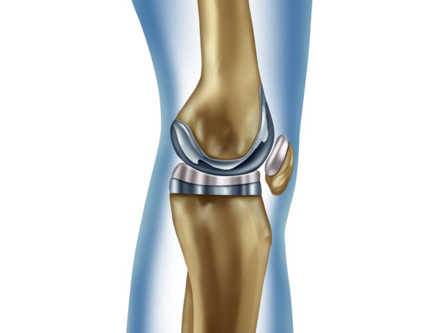 knee replacement