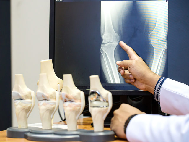 Orthopedic doctor pointing on the knee problem point