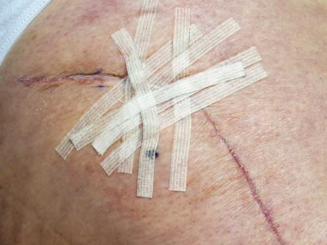 Healing hip replacement wound with steri-strips