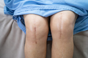 total knee replacement