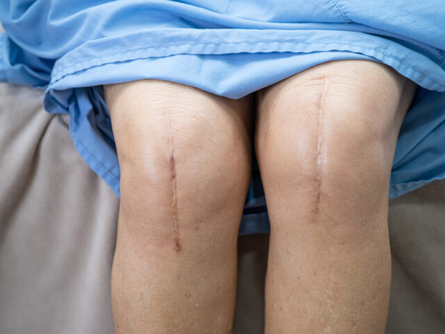 total knee replacement
