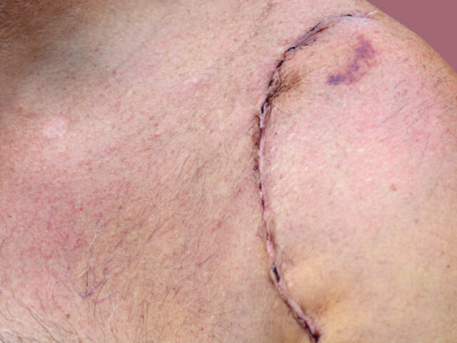 patient shoulder after Minimally Invasive Surgery