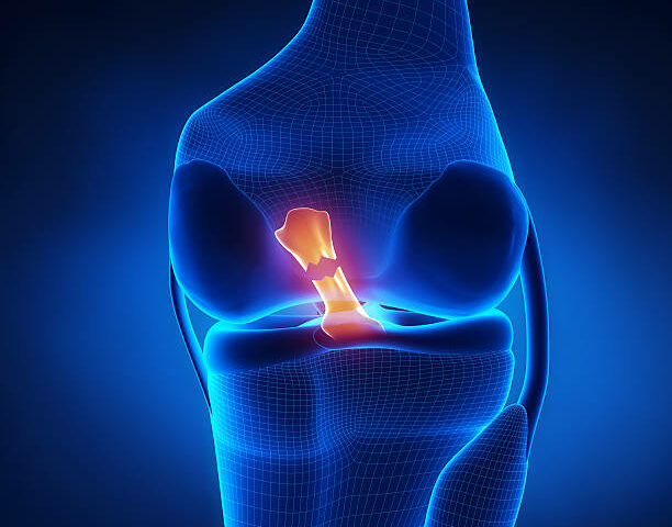 Torn Anterior Cruciate Ligament in x-ray view
