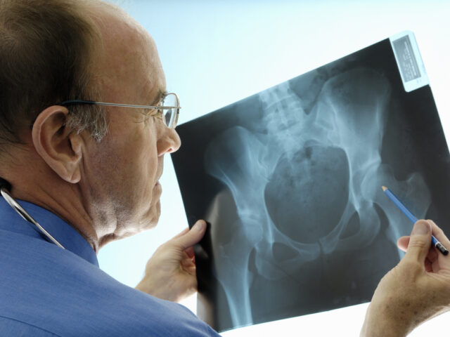 Orthopaedic surgeon consulting pelvic x-rays for a hip replacement