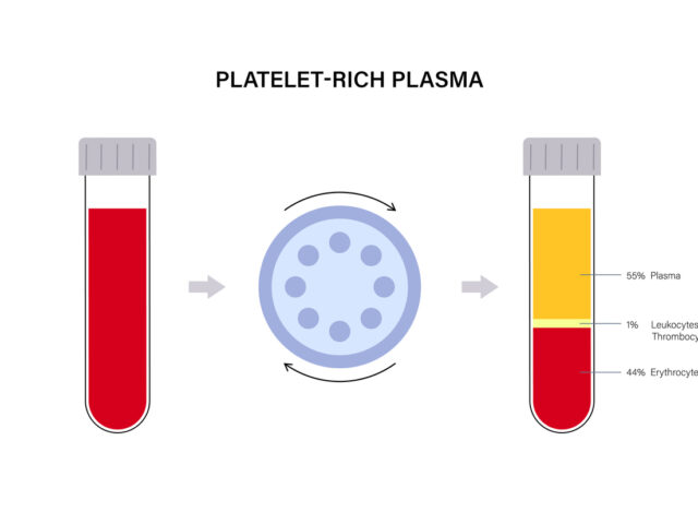 Platelet rich plasma concept