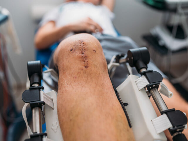 Close-up Of A Patient's Scar After Knee Replacement Surgery