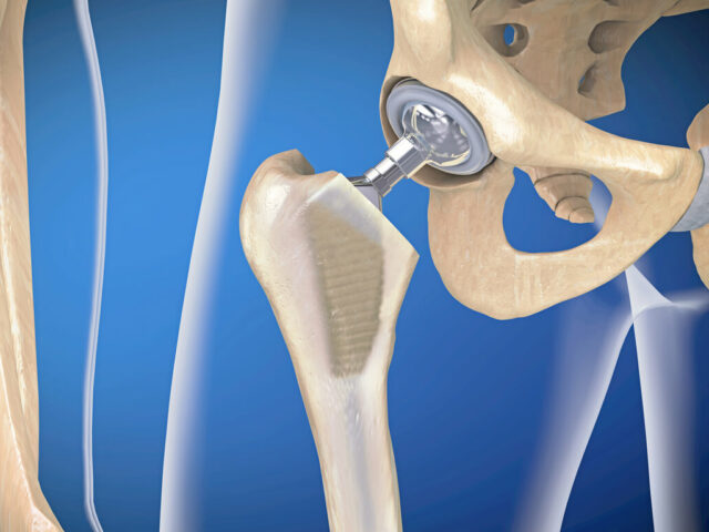 A 3D illustration of a hip joint implant for a person who has just undergone hip replacement surgery.