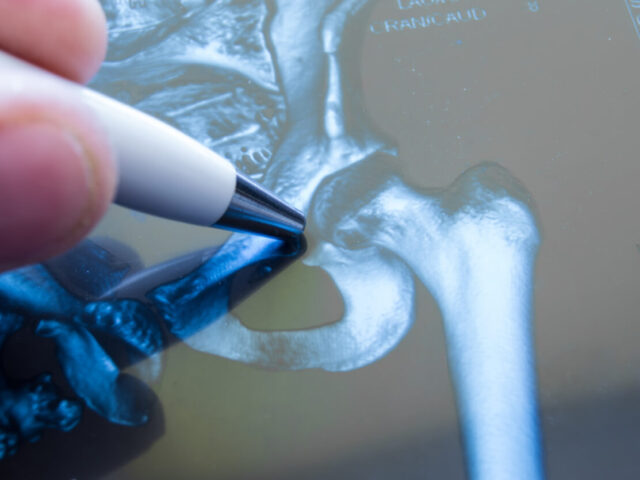 X-ray of hip joint. Doctor pointed on area of hip joint for the hip surgery.