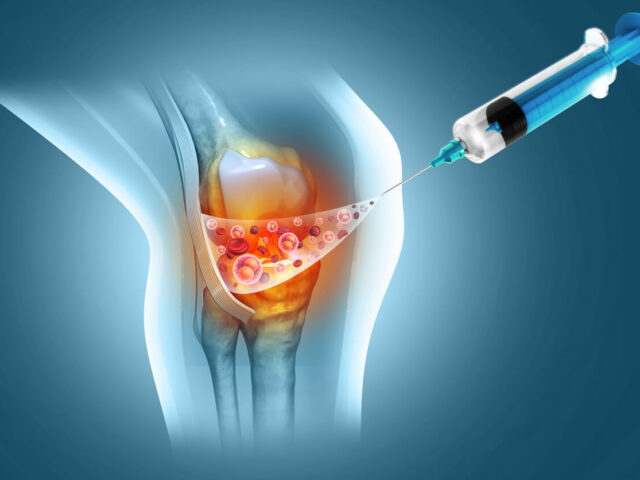 3d illustration of Injection into the knee joint. Platelet Rich Plasma for Knee Osteoarthritis and Knee pain